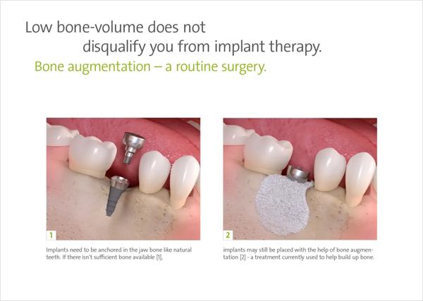 implant-faq-bone-augmentation